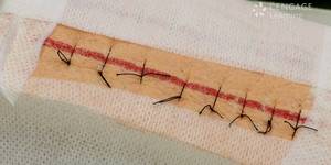 Complex wounds – drain, suture or clip removal