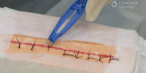 67. Complex wounds: drain and suture, staple or clip removal